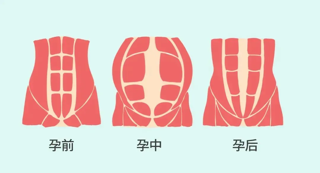 盆底修復2.png